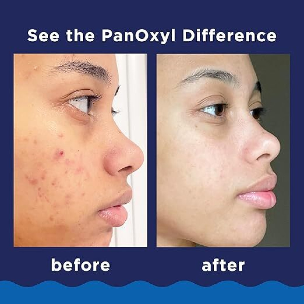 PanOxyl Acne Foaming Wash Benzoyl Peroxide 10% Maximum Strength Antimicrobial, 5.5 Oz - 2